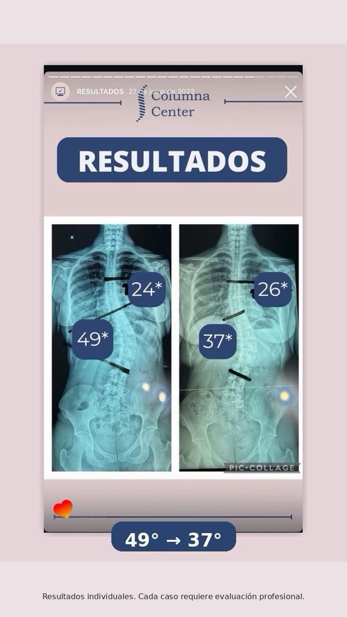 Radiografía antes y después, reducción de 49 a 37 grados
